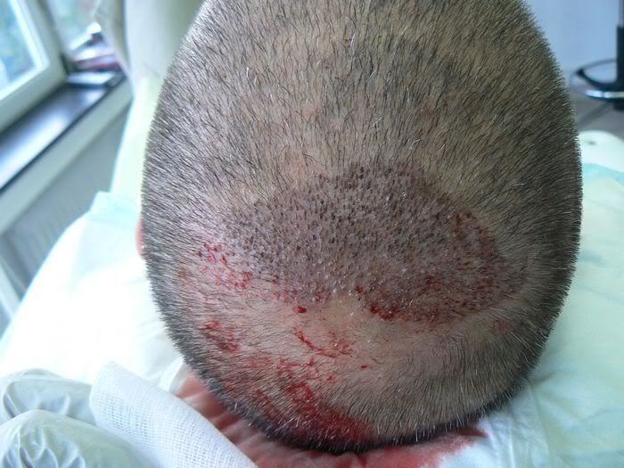 植在头顶的胡子毛囊